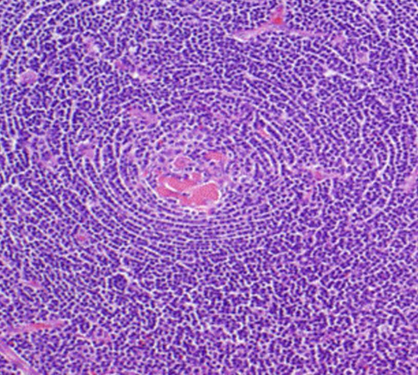 Overview of Castleman disease Published in High-Impact Medicine Journal