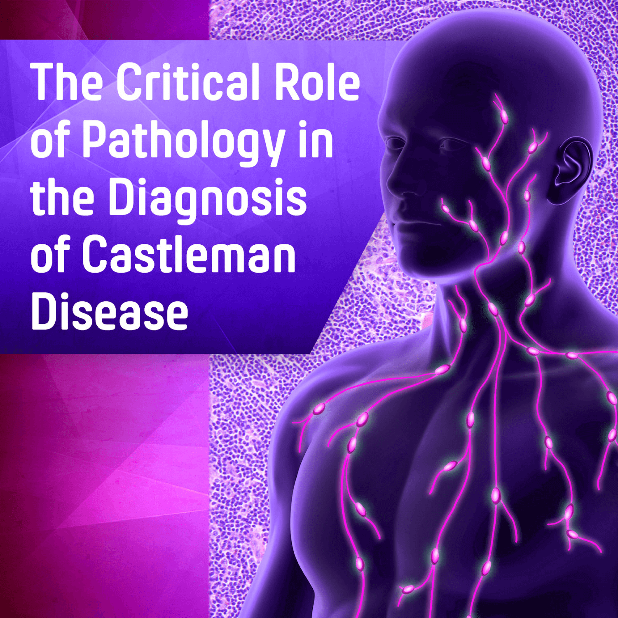 The Critical Role of Pathology in the Diagnosis of Castleman Disease