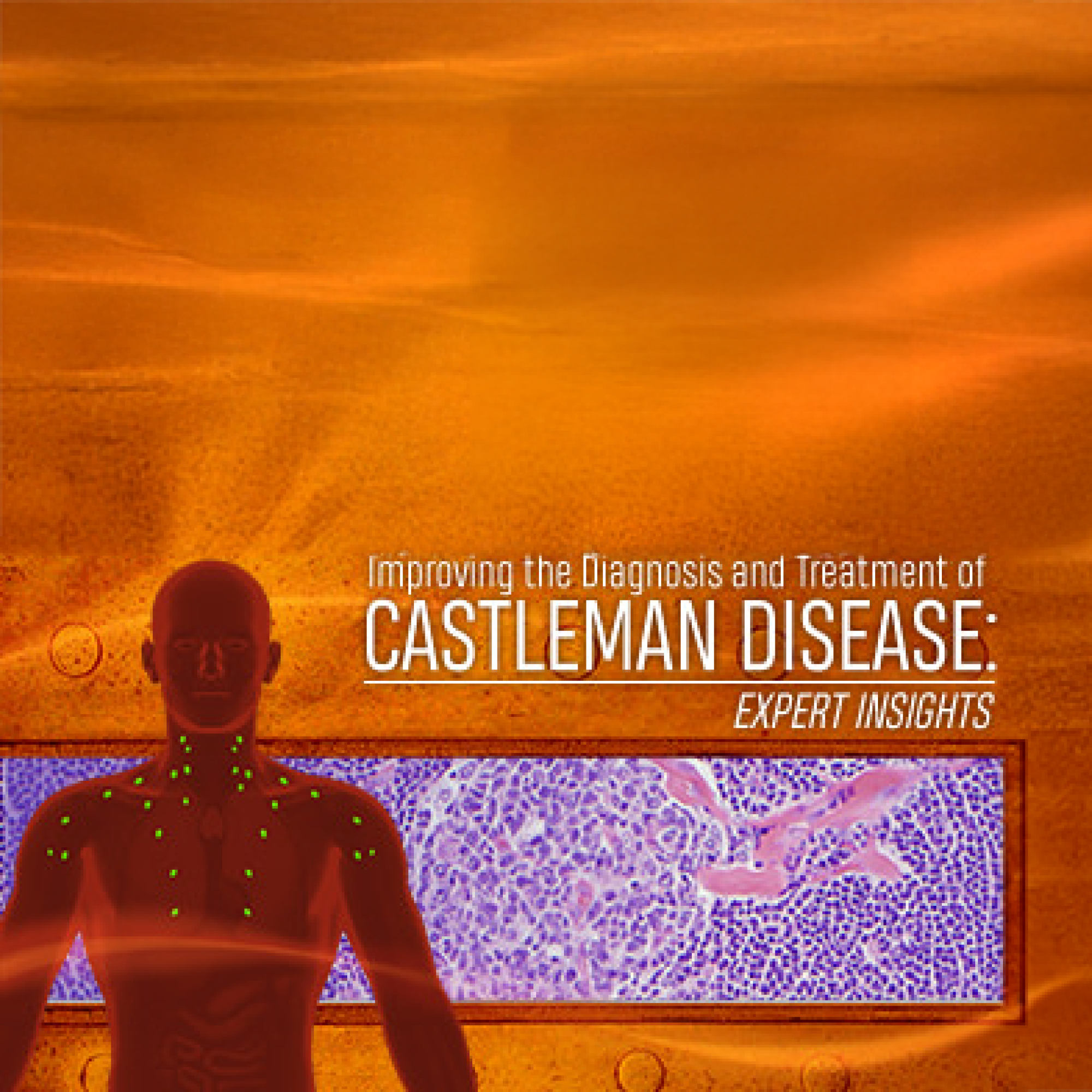 Updates in the Diagnosis and Treatment of Castleman Disease: Expert Perspectives