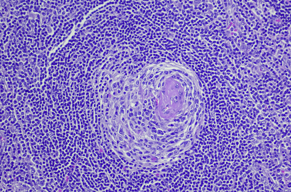First new subtype of Castleman disease discovered in 45 years